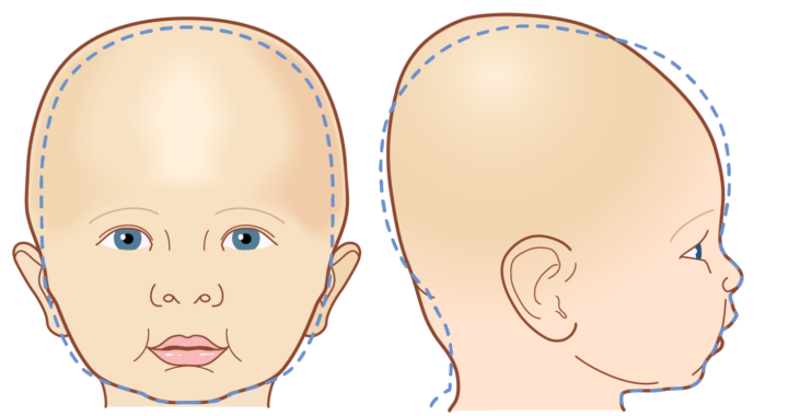 Braquicefalia en bebés
