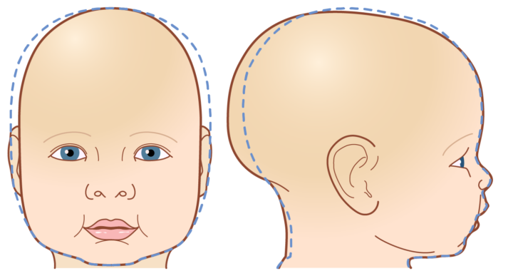 Casco corrector para bebés con escafocefalia