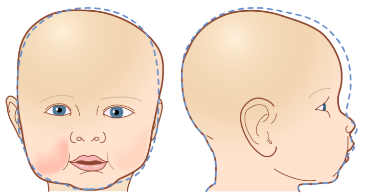 Plagiocefalia infantil y corrección con casco ortopédico